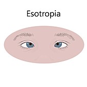 Childhood esotropia, illustration
