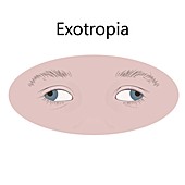 Childhood exotropia, illustration