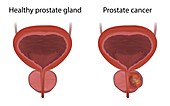 Prostate cancer and healthy prostate gland, illustration