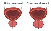 Enlarged and healthy prostate, illustration