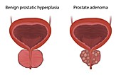 Adenoma and benign prostatic hyperplasia, illustration