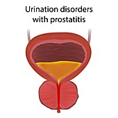 Urinary disorders with prostatitis, illustration