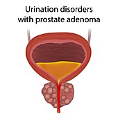 Urinary disorders with prostate gland adenoma, illustration