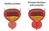 Urinary disorders and healthy urination, illustration