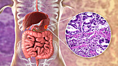 Human stomach cancer, illustration and light micrograph