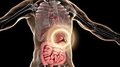 Human stomach cancer treatment, conceptual illustration