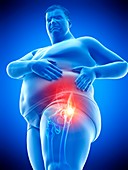 Obese man with hip pain, illustration