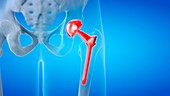Painful hip replacement, conceptual illustration