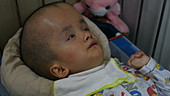 Child with hydrocephalus, Vietnam