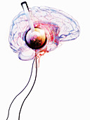Headphones on brain, illustration