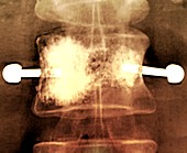 Vertebral augmentation in metastatic cancer, X-ray