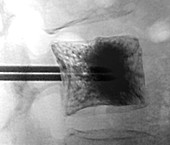 Vertebral augmentation in metastatic cancer, X-ray