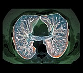 Secondary lung cancer, 3D CT scan