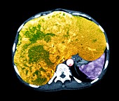 Liver cancer, CT scan