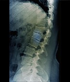 Spinal fracture, X-ray