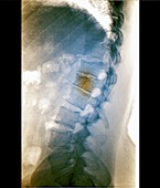 Spinal fracture, X-ray