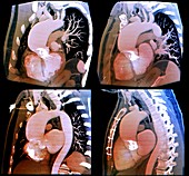 Thoracic aortic aneurysm, CTA scans