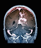 Cerebral arteriovenous malformation, MRA scan