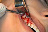 Apicoectomy dental surgery