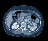 Pyelonephritis, axial CT scan