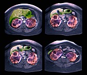 Polycystic kidney disease, MRI scans