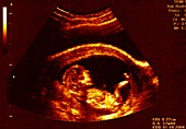 Foetus at 12 weeks, ultrasound scan