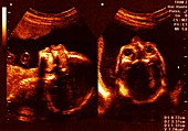 Foetus at 12 weeks, ultrasound scans