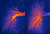 Lung blood vessels, angiograms