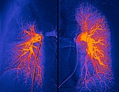 Lung blood vessels, angiograms