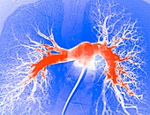 Lung blood vessels, angiogram