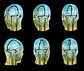 Brain veins and venous sinuses, 3D angiograms