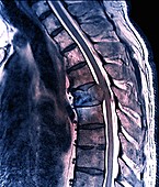 Secondary bone cancer in the spine, MRI scan