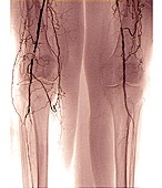 Nearly blocked femoral arteries, angiogram