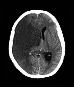 Stroke and brain damage, CT scan