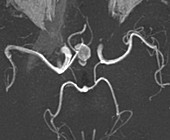 Cerebral haemorrhage and aneurysm, CT brain scan