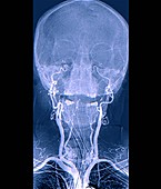 Brain death test, angiogram