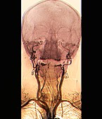 Brain death test, angiogram