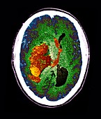 Stroke and brain damage, CT scan