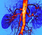 Kidney blood vessels, angiogram