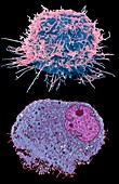 Leukaemia cell, SEM-TEM comparison