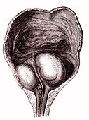 Prostate hypertrophy, 19th century