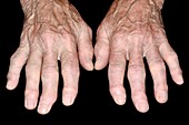 Hands in erosive osteoarthritis
