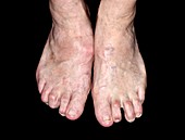 Feet in severe osteoarthritis
