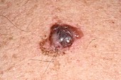 Malignant melanoma