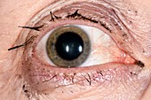 Dilated pupil for an eye examination