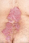 Psoriasis on the lower back