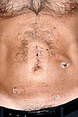 Surgical wounds after bowel cancer surgery