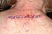 Malignant melanoma excision wound