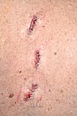 Basal cell carcinoma excision wounds