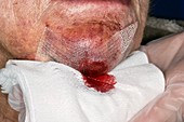 Bleeding from warfarin patient's chin